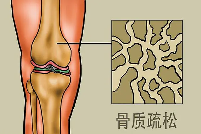 海带补钙