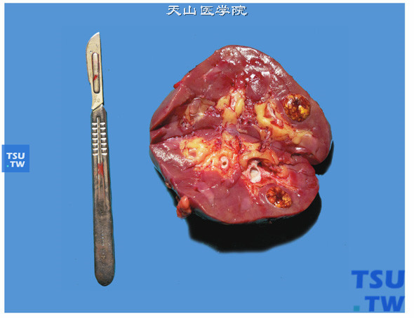 肺癌病人补硒副作用