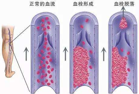 补硒对脑血栓的好处