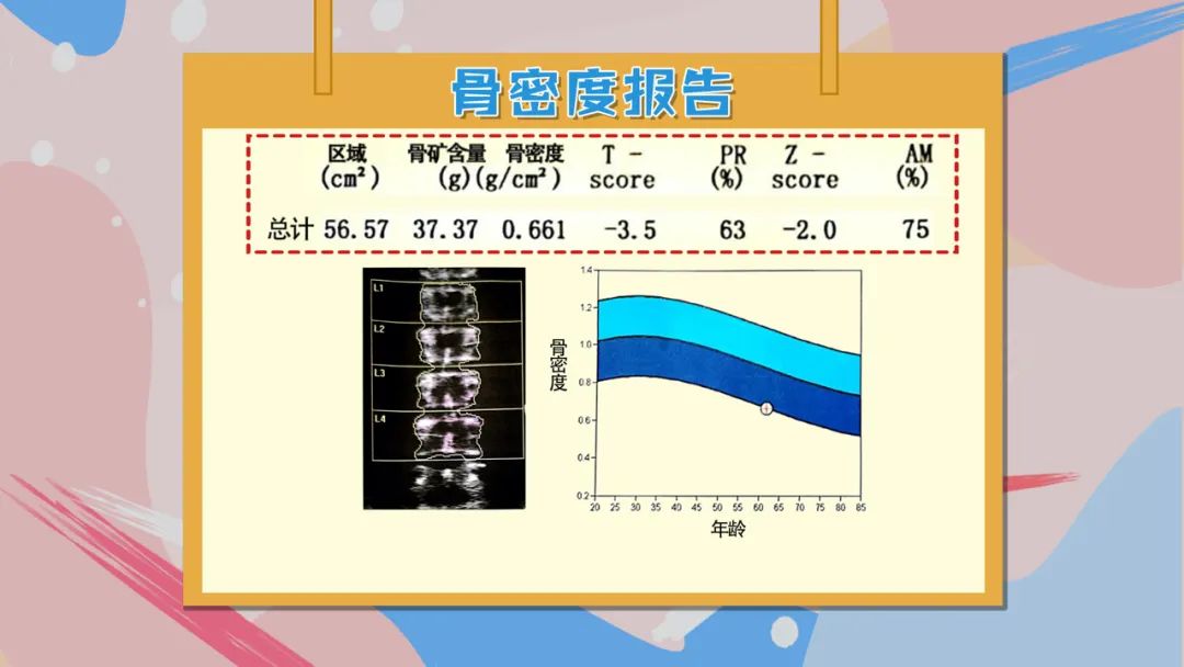 肾结石患者如何补钙