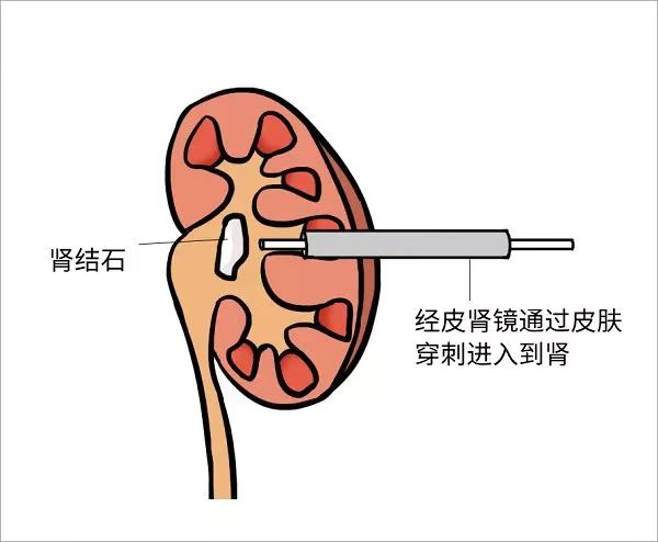 肾结石患者如何补钙