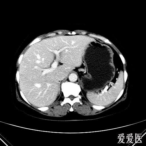 补硒对肝硬化的疗效