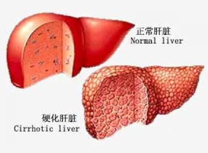 补硒能治疗肝硬化吗