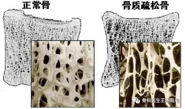 骨质疏松需要补钙吗