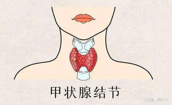 补硒预防甲状腺癌吗