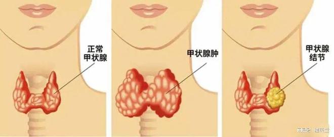 补硒预防甲状腺癌吗