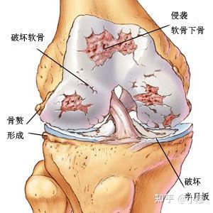 骨质增生需要补硒吗