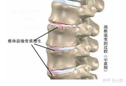 骨质增生需要补硒吗