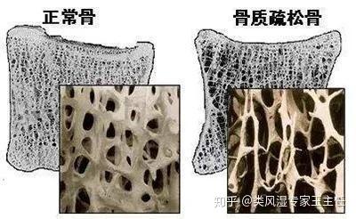 关节炎需要补钙吗