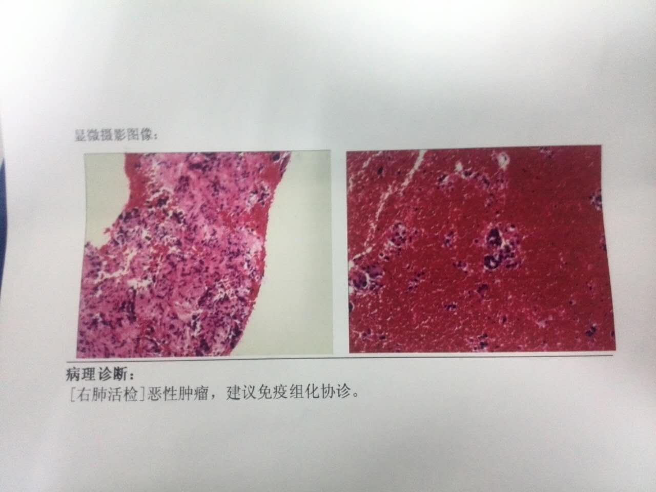 肺癌晚期补硒有用吗