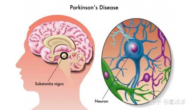 补硒能治帕金森病吗