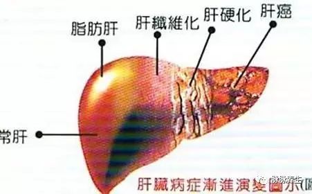 脂肪肝补硒可以吃吗