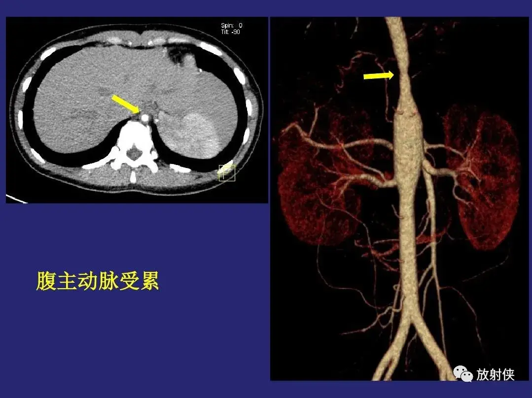 大动脉炎需要补硒吗