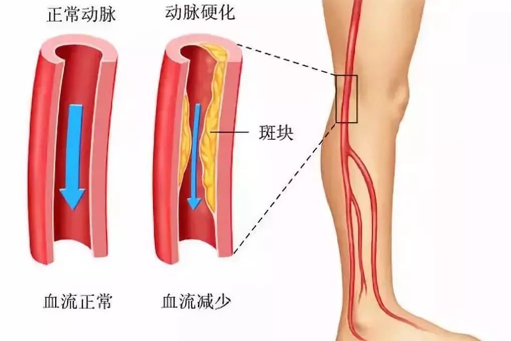 老人 补钙