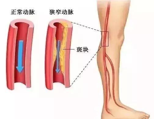 老年人腿抽筋吃什么钙片补钙最好