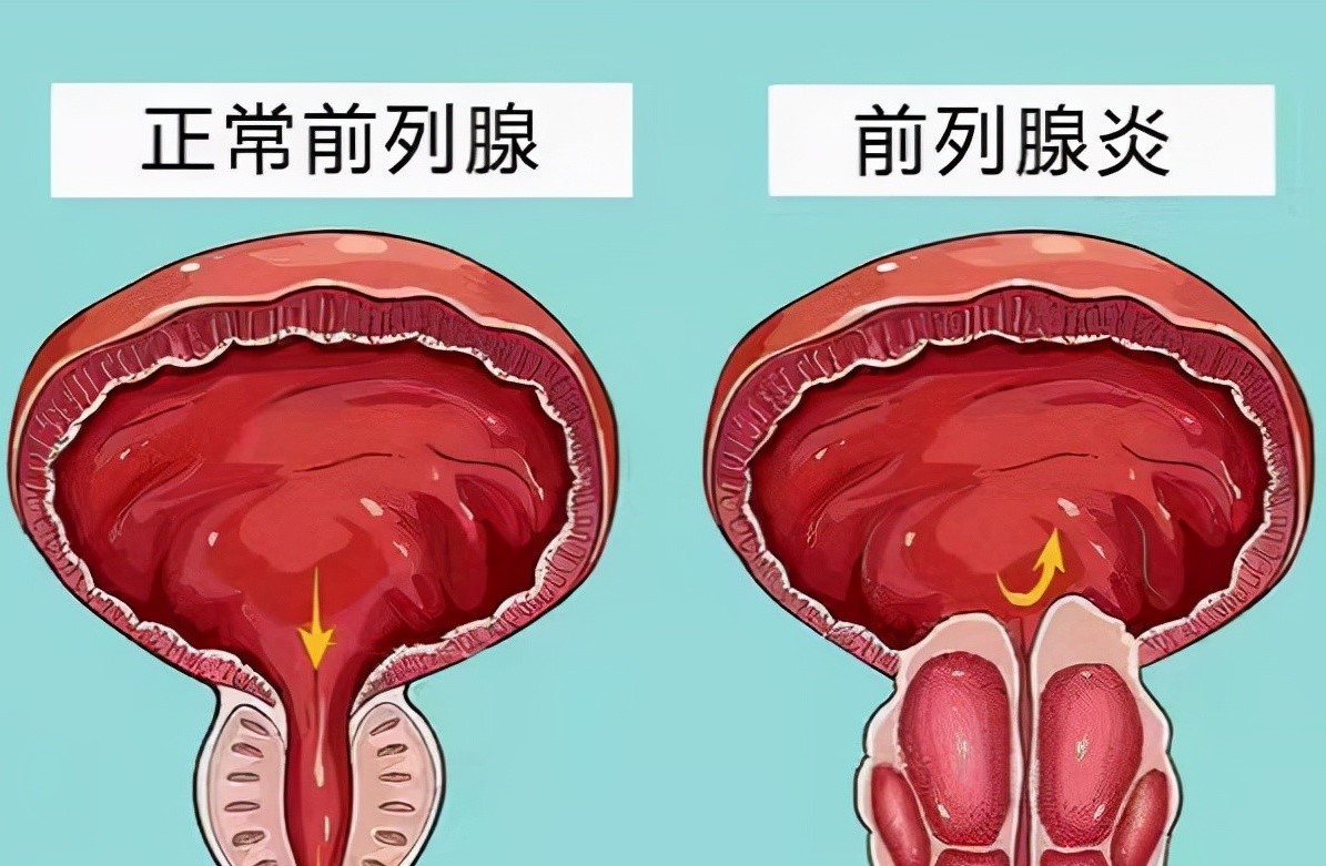 锌硒宝前列腺炎观察