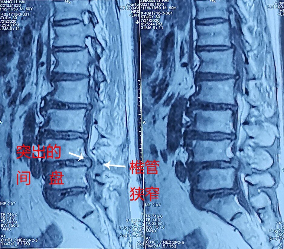 腰间盘突出要补钙吗