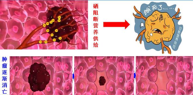 肿瘤患者补硒有什么用