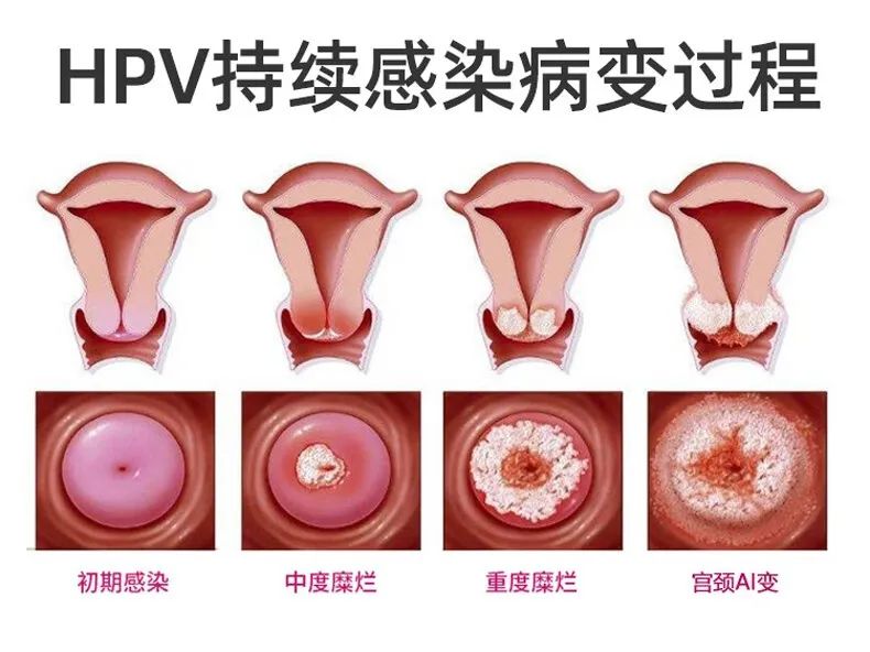 补硒有助于抗hpv吗