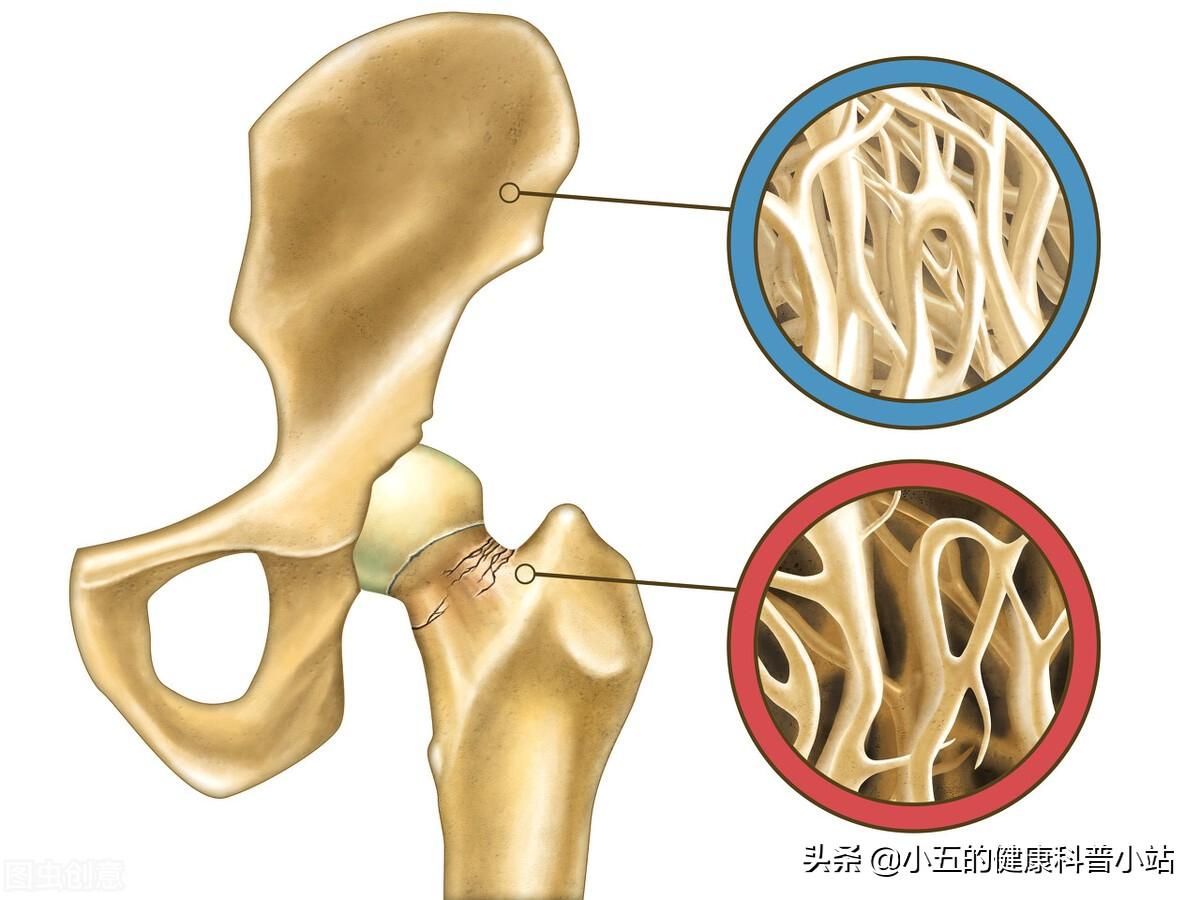 腰疼吃什么钙片补钙效果好