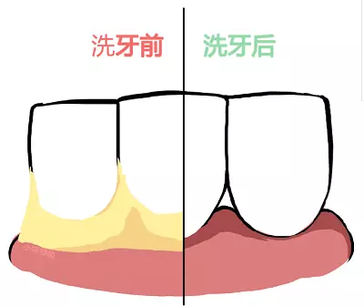 补钙对牙齿有好处吗