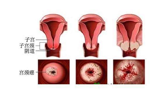 富硒茶宫颈癌可以喝吗