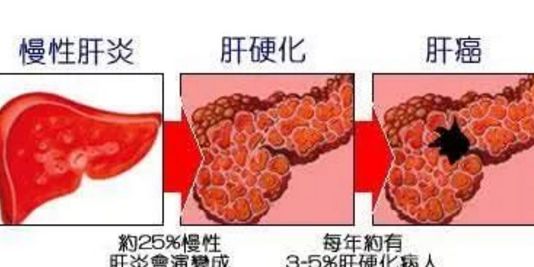 酒精性肝硬化喝富硒茶