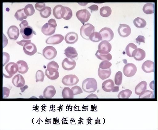 轻型地贫补铁会加重吗