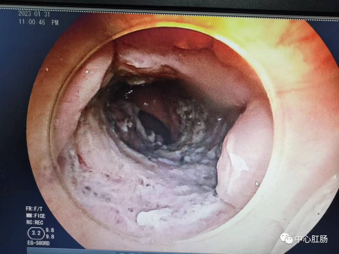 管状腺瘤切除可以补硒吗