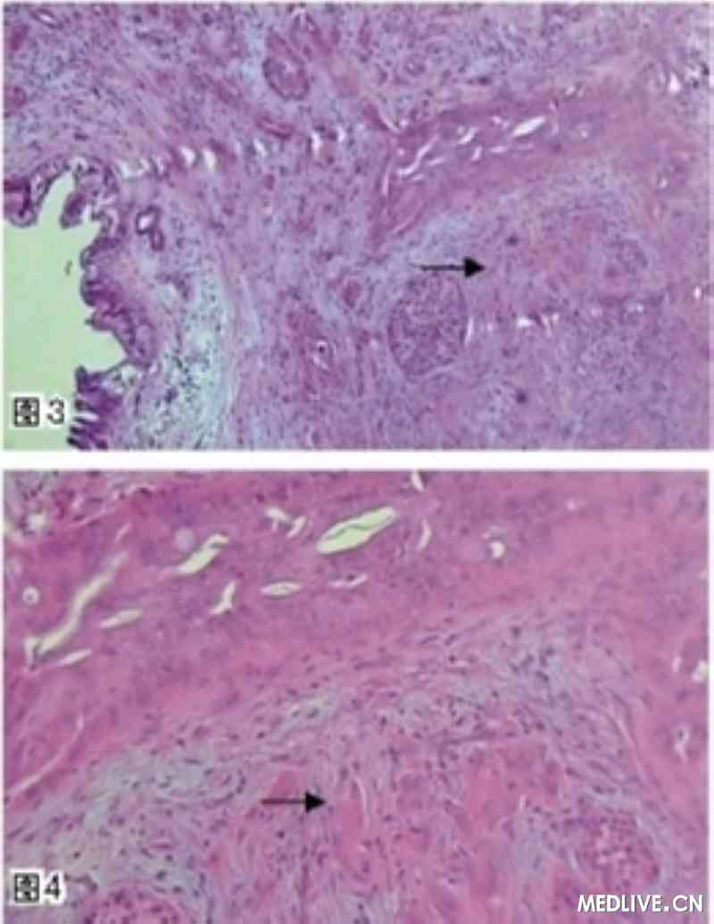 胰腺癌患者补硒康复时间