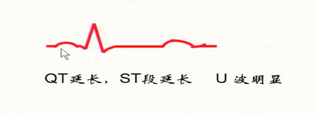 补钙注射哪种效果好