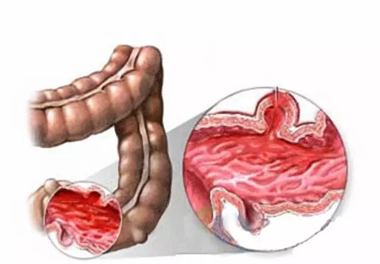 胃息肉手术后可以补硒吗