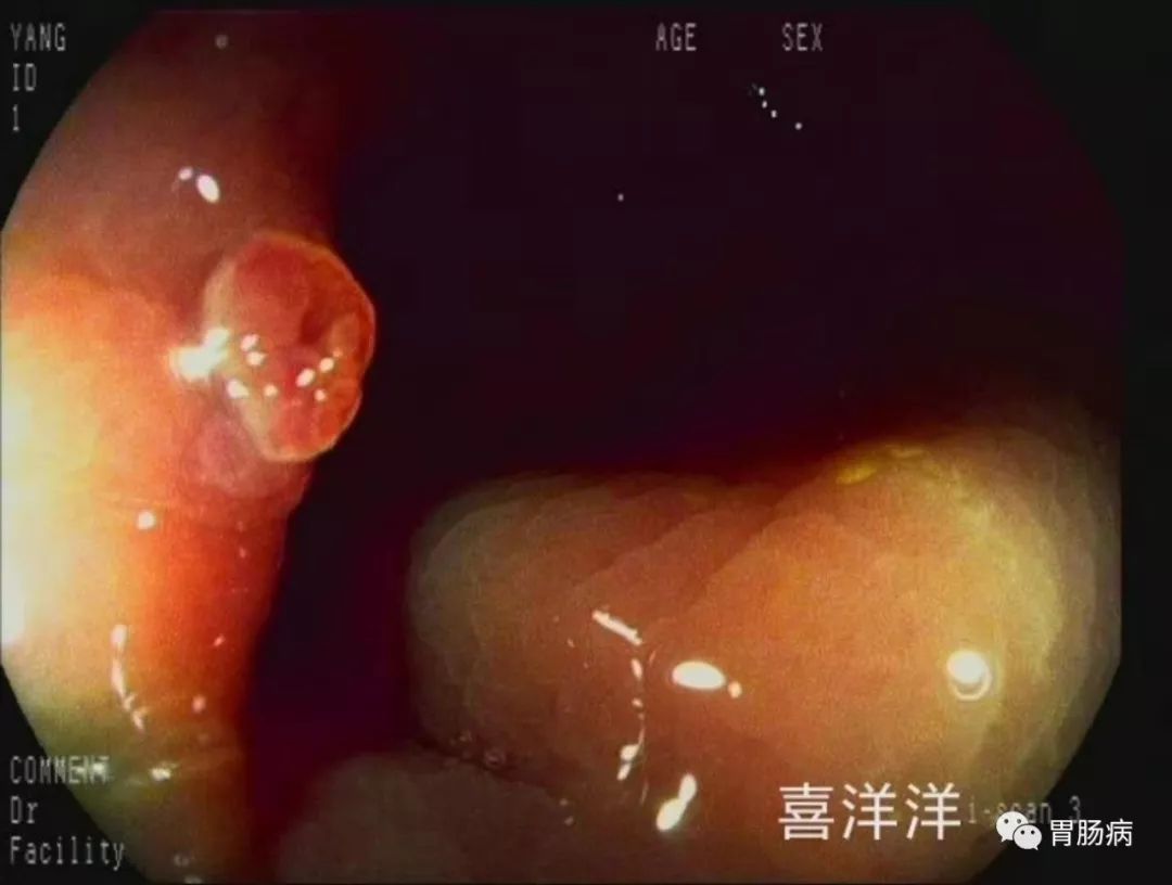 胃息肉手术后可以补硒吗