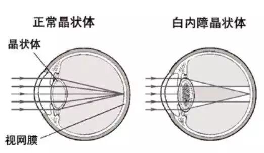 补多少硒防白内障最好呢