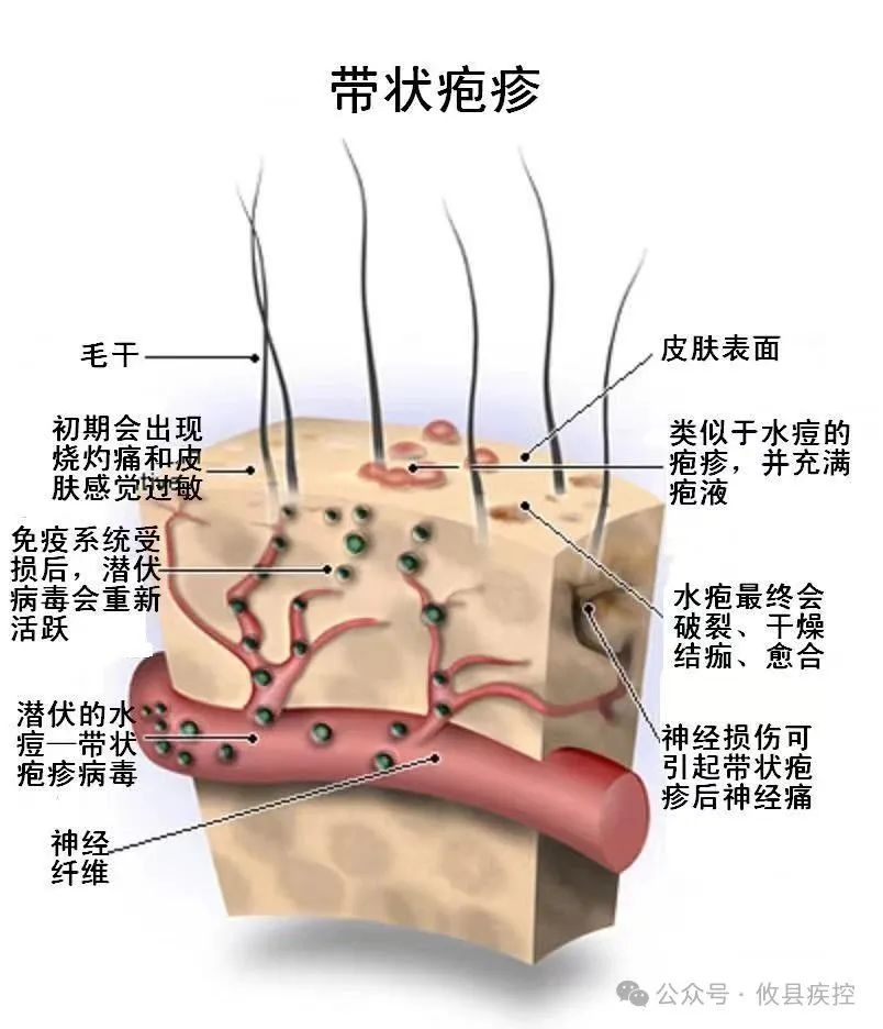 得过带状疱疹需要补硒吗