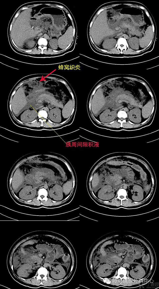 补硒对慢性胰腺炎的作用