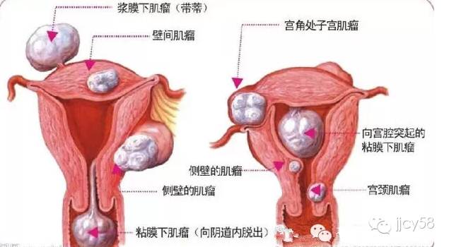 卵巢囊肿为什么要补硒呢