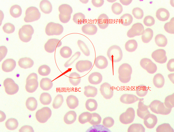 补铁一般补多长时间