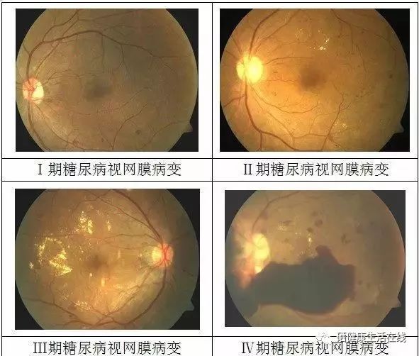 糖尿病每天补硒量为多少