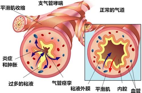 支气管炎哮喘可以补硒吗