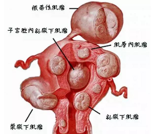 硒产品对子宫肌瘤的作用