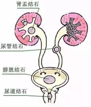 吃硒维康会导致肾结石吗