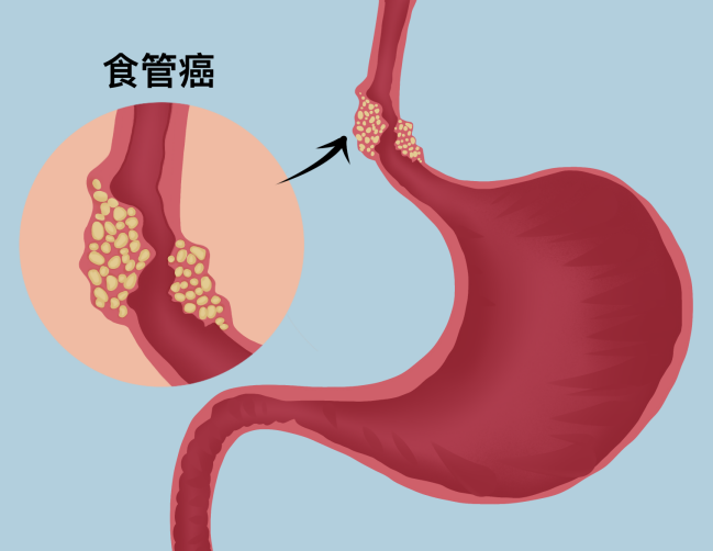 食管癌患者能吃硒维康吗