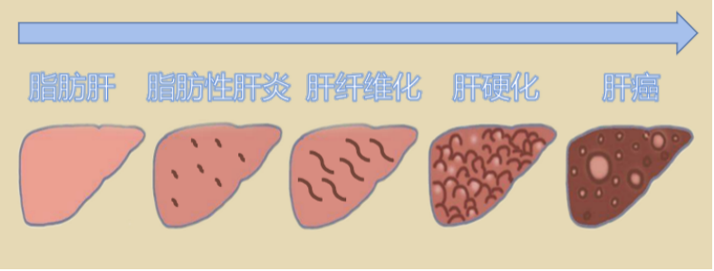 脂肪肝中度能吃硒维康吗